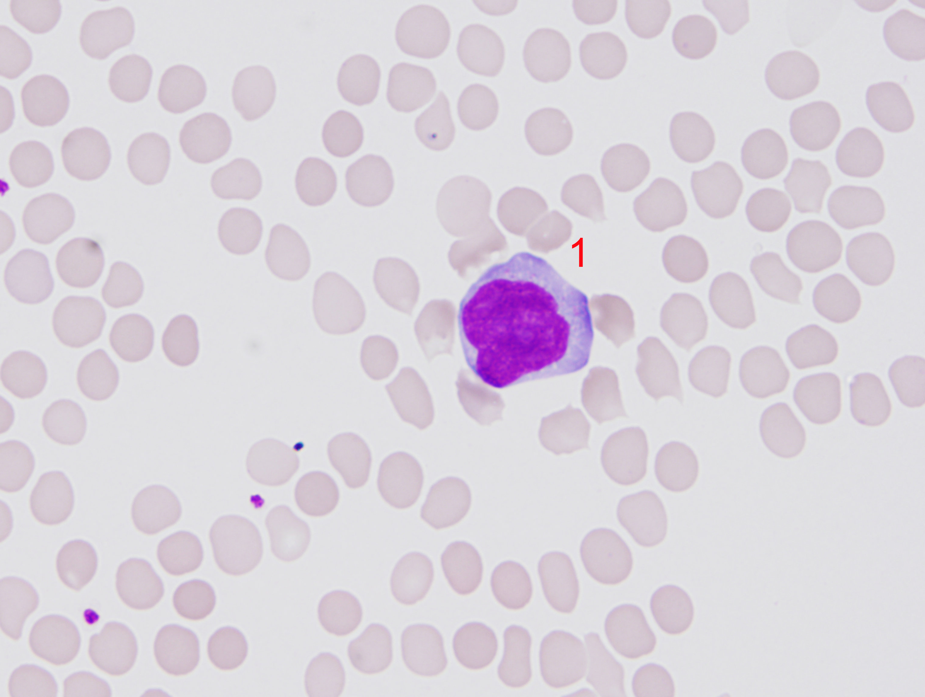 a. 异型淋巴细胞